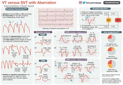 Ventricular Tachycardia Vs Supraventricular Tachycardia