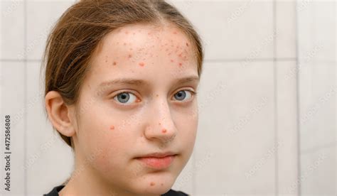 face of a teenage girl with pimples, acne on the skin, portrait of ...