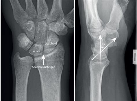 Scapholunate ligament Injuries – Cornwall Virtual Hand Clinic