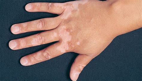 Treatment of Vitiligo?