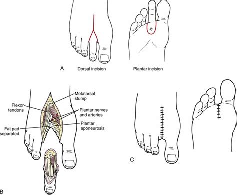 Amputation causes, types of amputation and amputation complications