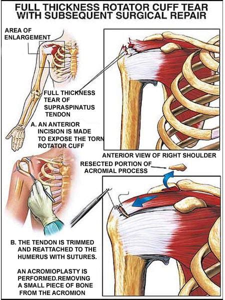 Infographic on Rotator Cuff Injury