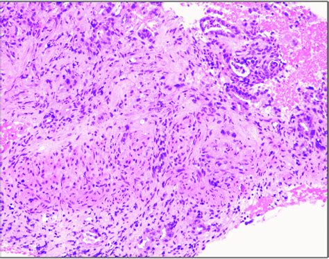 Histology of pancreatic adenocarcinoma acquired from endoscopic ...