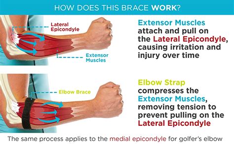 Pickleball: Tennis Elbow (Lateral Epicondylitis) – CoreNewport