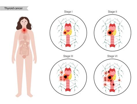 Premium Vector | Thyroid cancer stages