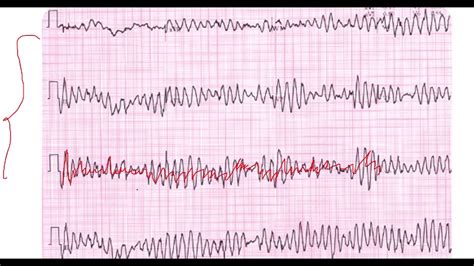 Ventricular Flutter Vs Torsades Porn Sex Picture