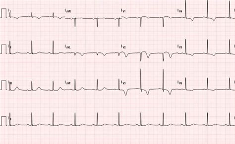 Wellens’ Sign (Wellens’ Syndrome) - JETem