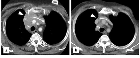 (a) CT reveals the presence of anterior mediastinal lymph node ...