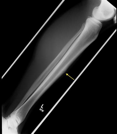 [DIAGRAM] Diagram Of Tibia Stress Fracture - MYDIAGRAM.ONLINE