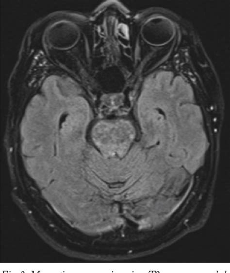 Figure 2 from PRIMARY ANGIITIS OF THE CENTRAL NERVOUS SYSTEM – A ...