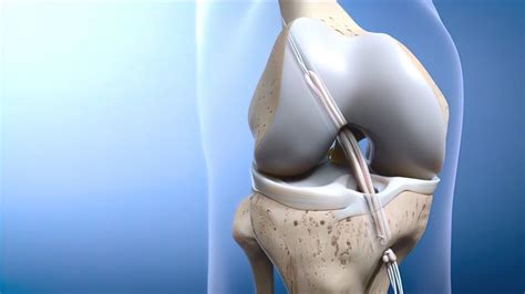 When Does an ACL Tear Require Surgery?: Sumit Dewanjee, MD: Orthopedic ...