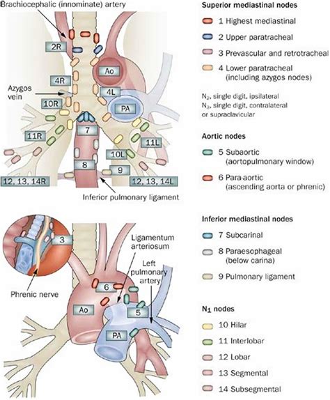 Mediastinal lymph nodes, mediastinal lymphadenopathy causes