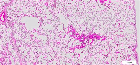 Emphysema Histology