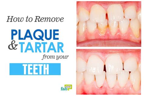 How to Remove Plaque and Tartar from Your Teeth | Fab How