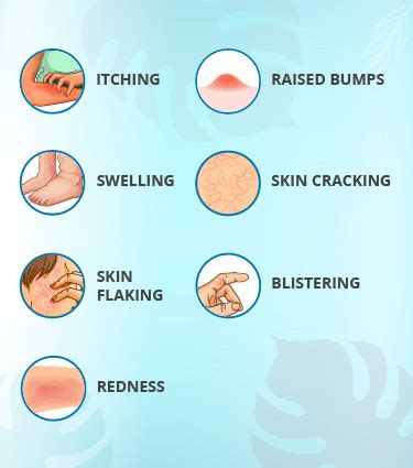 Aggregate more than 72 mehndi allergy symptoms best - seven.edu.vn