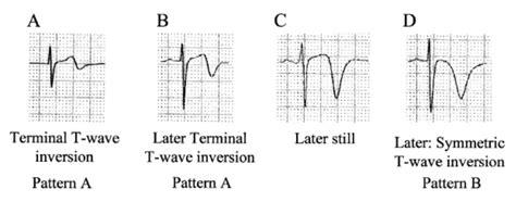 R.E.B.E.L. ECG of the Week: Wellens' Syndrome or STEMI - REBEL EM ...