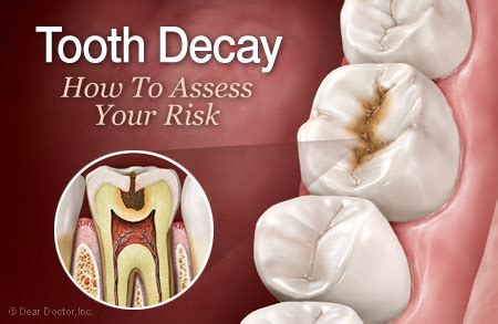 Tooth Decay — How To Assess Your Risk