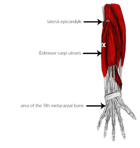 Extensor carpi ulnaris pain & trigger points