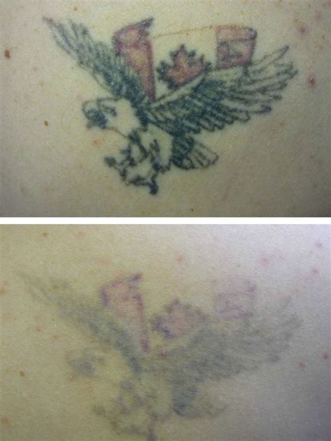 Fading Fast - Laser Tattoo Removal and Fading Specialist