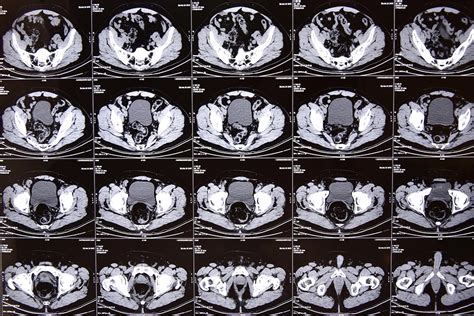 What Does My Doctor Do With The Results Of My Pelvic CT Scan