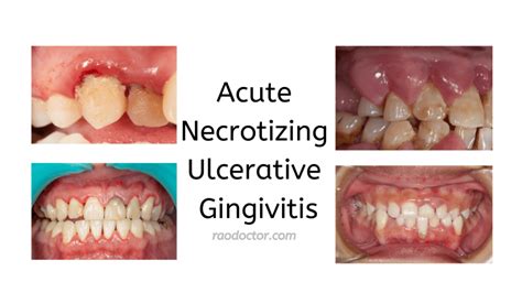 Acute Necrotizing Ulcerative Gingivitis-8 Signs And Symptoms