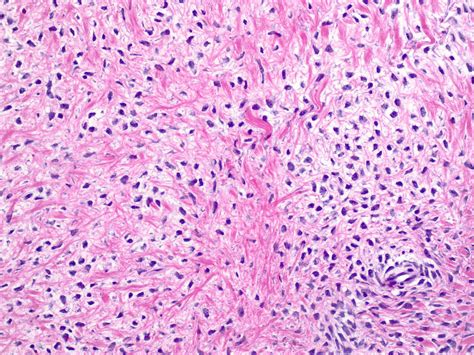 Irritation Fibroma Histology