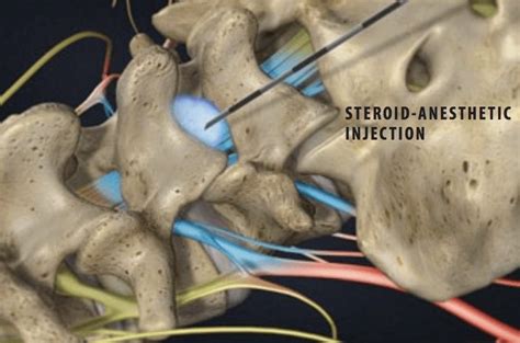 Side Effects Of Epidural Steroid Injections | Tampa, FL