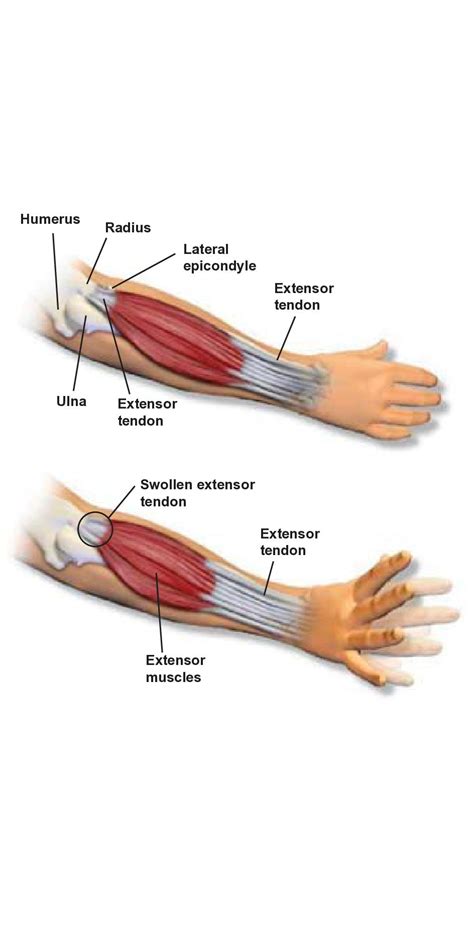 Lateral Epicondylitis