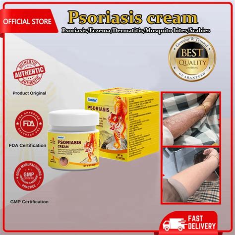 antifungal cream eczema cream and psoriasis ointment Skin itching cream ...