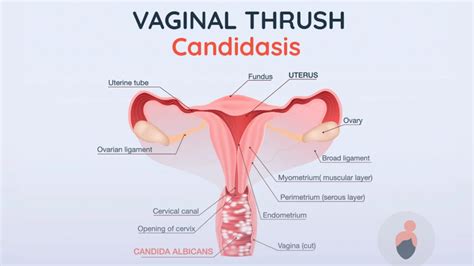 Vaginal Thrush - Everything You Need to Know