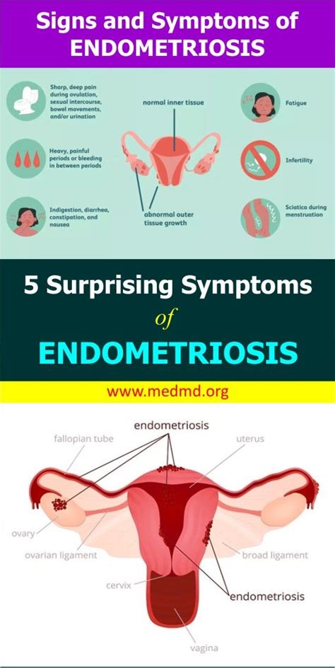 Endometriosis Symptoms