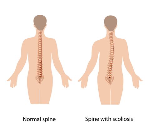 Mild Scoliosis Exercises