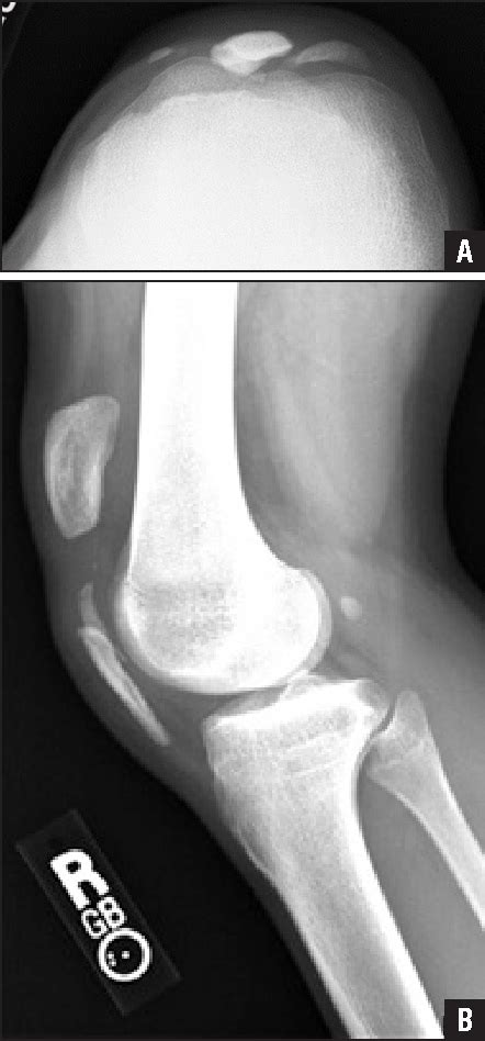 Figure 1 from Patellar Sleeve Fracture With Ossification of the ...