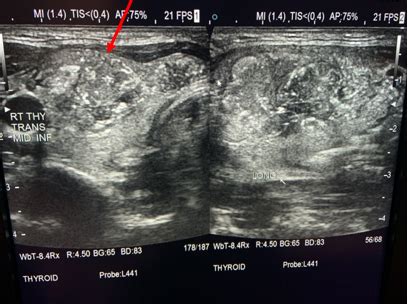 Thyroid Cancer Ultrasound