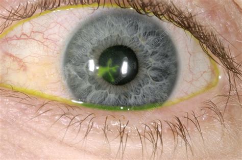 Eye ulcer - Stock Image - C002/4931 - Science Photo Library