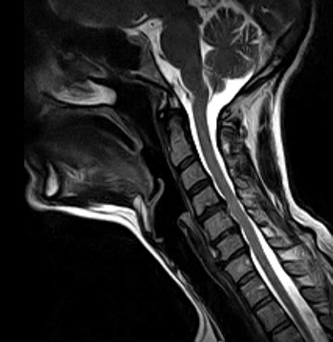 Cervical Spine MRI scan | Medserena Open MRI