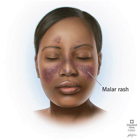 Lupus Rash: Types, Causes, Treatment & Prevention