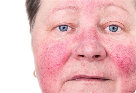 Rosacea - Symptoms, Causes, Treatment and Photos