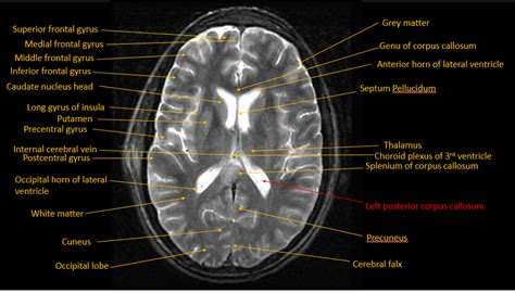 Corpus Callosum Mri