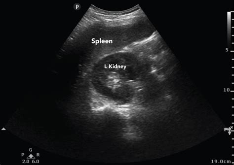 Abnormal Spleen Ultrasound