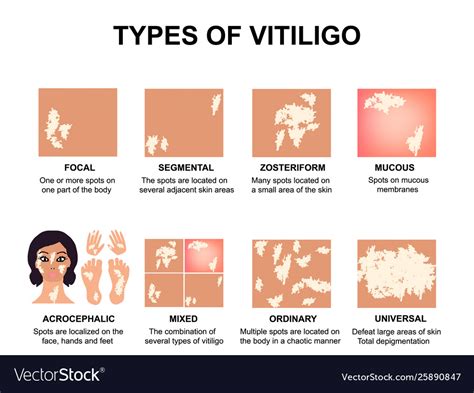 Types vitiligo world vitiligo day Royalty Free Vector Image