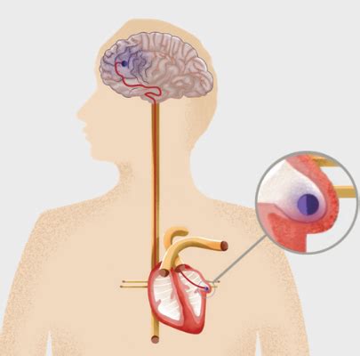 Atrial Fibrillation & Stroke Prevention Management - Heart and Vascular ...