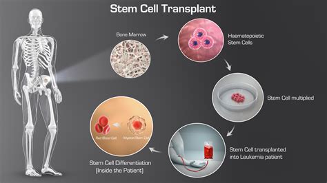 StemCellTransplant - IOW47 - Scientific Animations