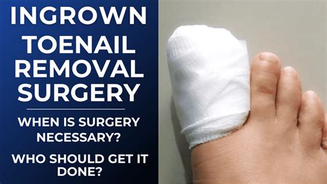 What is Ingrown Toenail removal surgery? How does it work? Does it hurt?