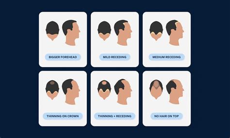 The 7 Receding Hairline Stages Explained | Pilot