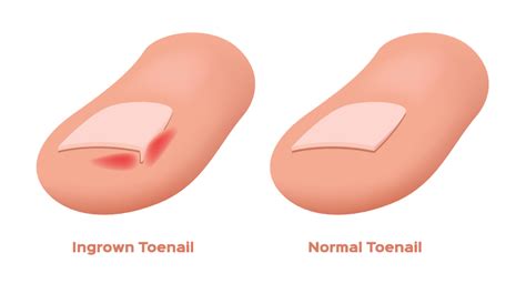 Ingrown Toenail Causes, Remedies and Treatment