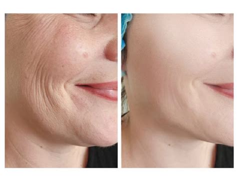 Hyaluron Pen Lip Filler in Fort Myers, FL | Medical Spa