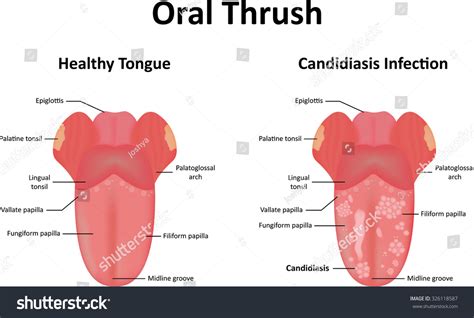 Oral Thrush Illustration - 326118587 : Shutterstock