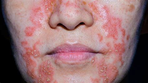 Eczema In Pictures | Everyday Health