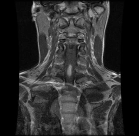 Cervical Spine MRI With Contrast